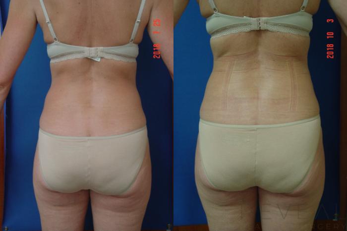 Before & After Tummy Tuck Case 260 View #3 View in San Jose, CA
