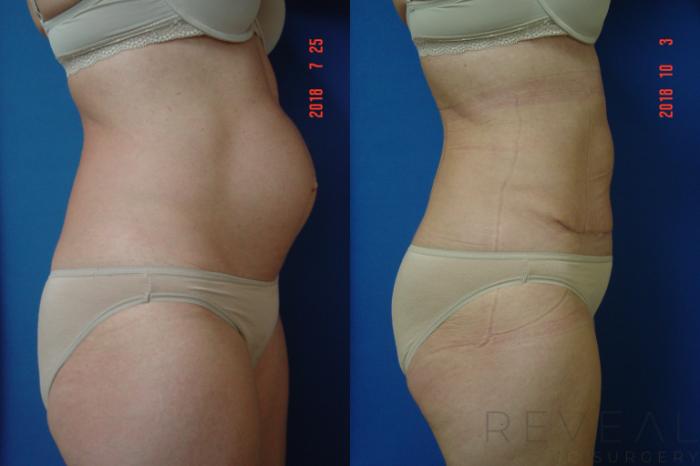 Before & After Tummy Tuck Case 260 View #4 View in San Jose, CA
