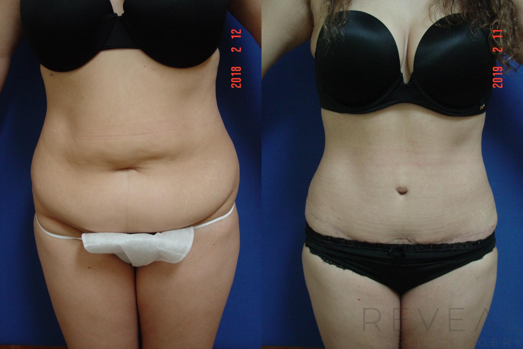 Before & After Tummy Tuck Case 301 View #1 View in San Jose, CA