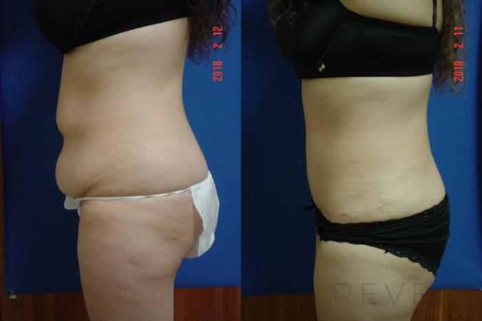 Before & After Tummy Tuck Case 301 View #2 View in San Jose, CA