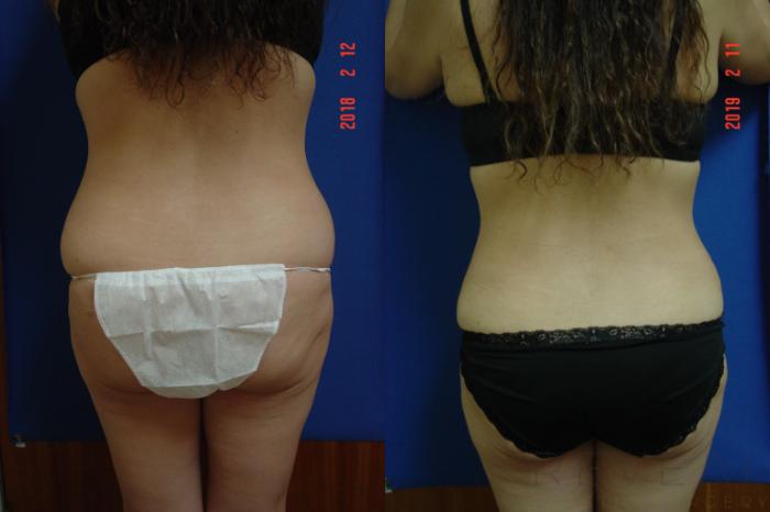 Before & After Tummy Tuck Case 301 View #3 View in San Jose, CA
