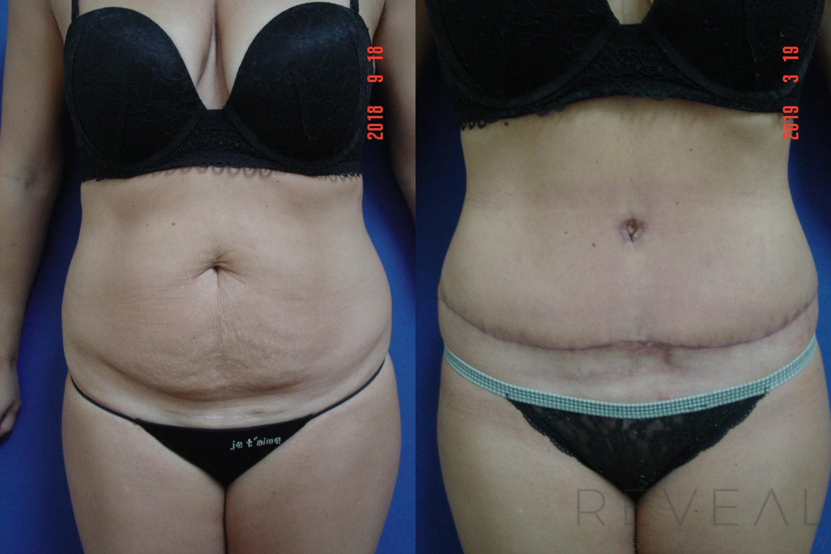 Before & After Tummy Tuck Case 317 View #1 View in San Jose, CA