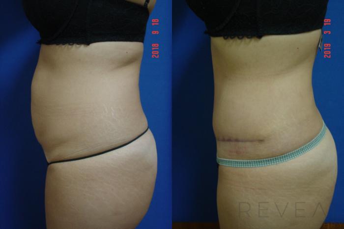 Before & After Liposuction Case 317 View #2 View in San Jose, CA