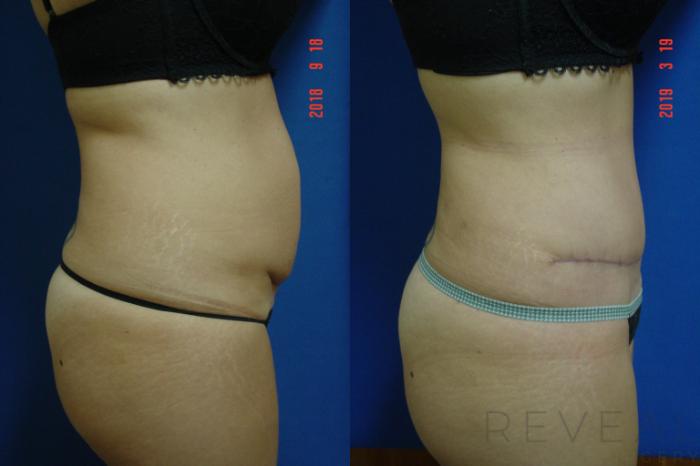 Before & After Liposuction Case 317 View #3 View in San Jose, CA