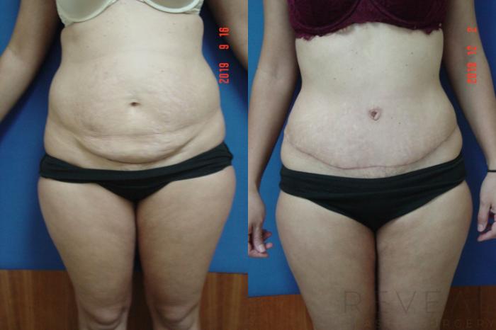 Before & After Tummy Tuck Case 376 View #1 View in San Jose, CA