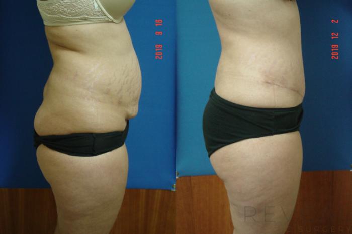 Before & After Liposuction Case 376 View #2 View in San Jose, CA