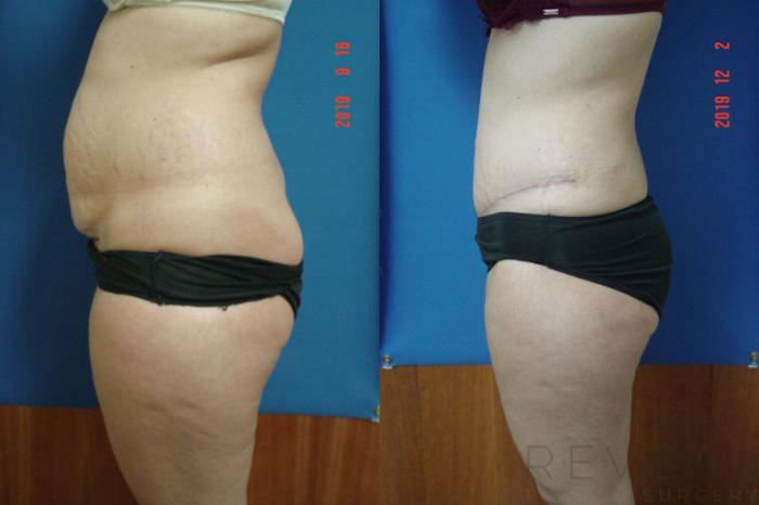 Before & After Tummy Tuck Case 376 View #3 View in San Jose, CA