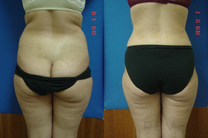 Before & After Tummy Tuck Case 376 View #4 View in San Jose, CA