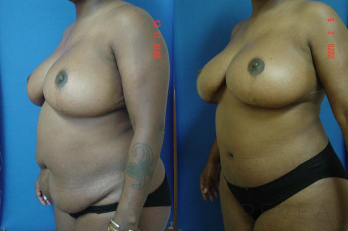 Before & After Tummy Tuck Case 390 View #2 View in San Jose, CA
