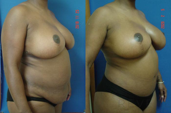 Before & After Tummy Tuck Case 390 View #3 View in San Jose, CA