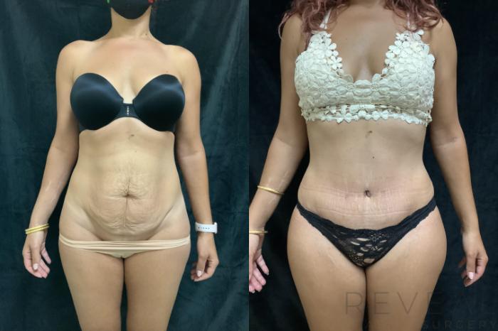 Before & After Tummy Tuck Case 408 View #1 View in San Jose, CA