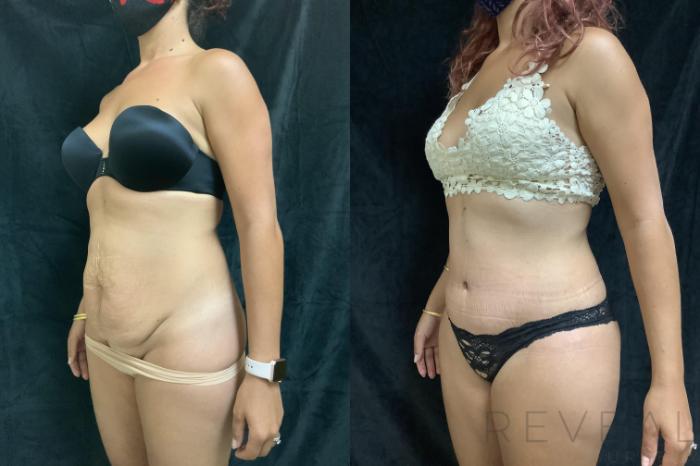 Before & After Tummy Tuck Case 408 View #2 View in San Jose, CA