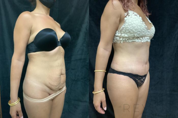 Before & After Tummy Tuck Case 408 View #3 View in San Jose, CA