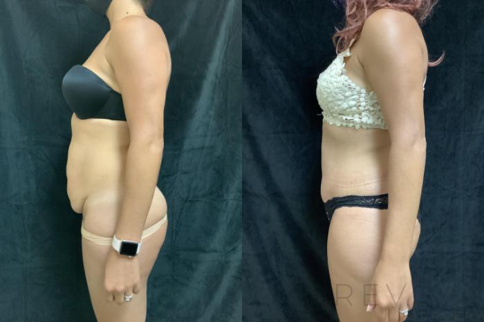 Before & After Tummy Tuck Case 408 View #4 View in San Jose, CA