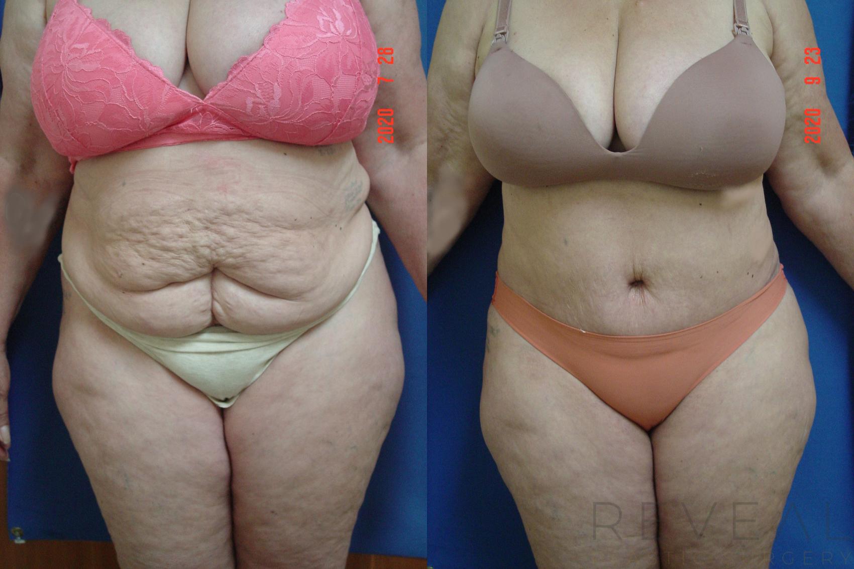 Before & After Tummy Tuck Case 427 View #1 View in San Jose, CA