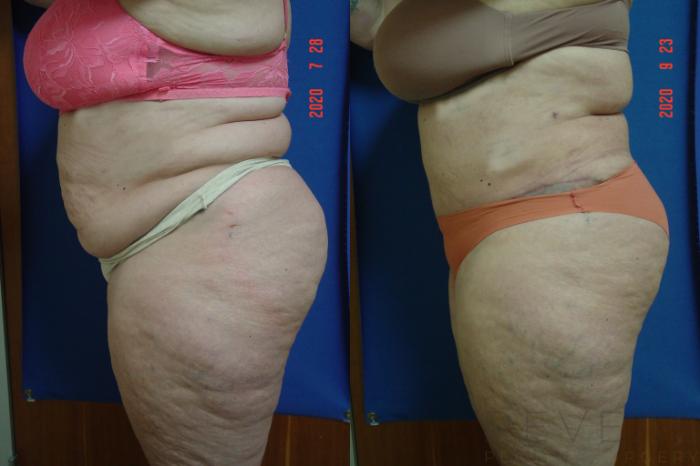 Before & After Tummy Tuck Case 427 View #2 View in San Jose, CA