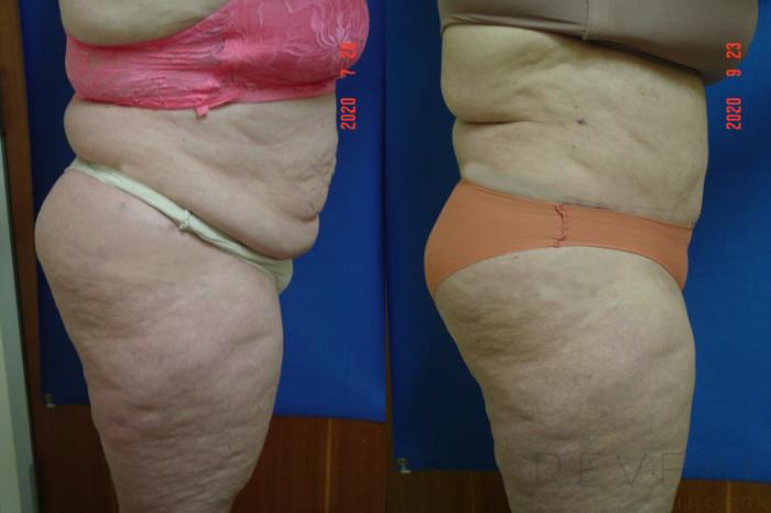 Before & After Tummy Tuck Case 427 View #3 View in San Jose, CA