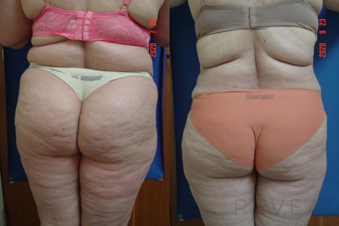 Before & After Tummy Tuck Case 427 View #4 View in San Jose, CA