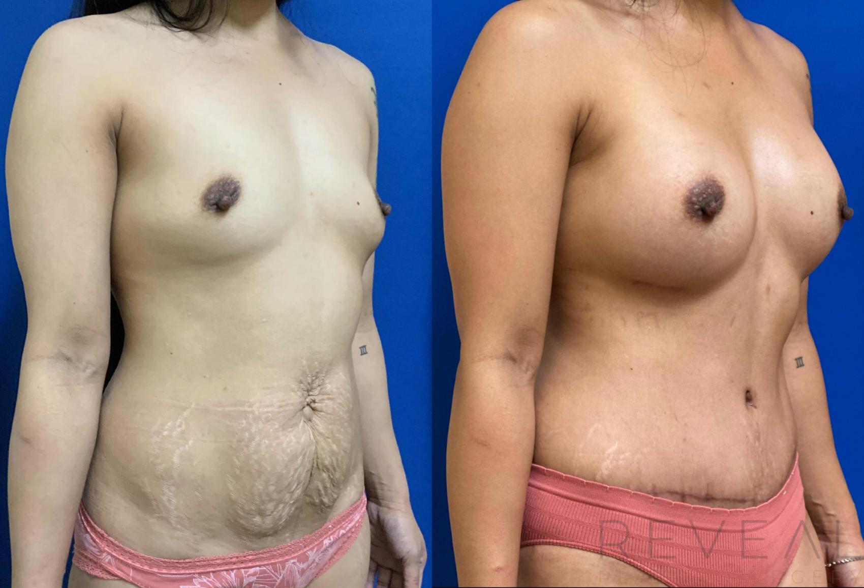 Before & After Tummy Tuck Case 436 View #1 View in San Jose, CA