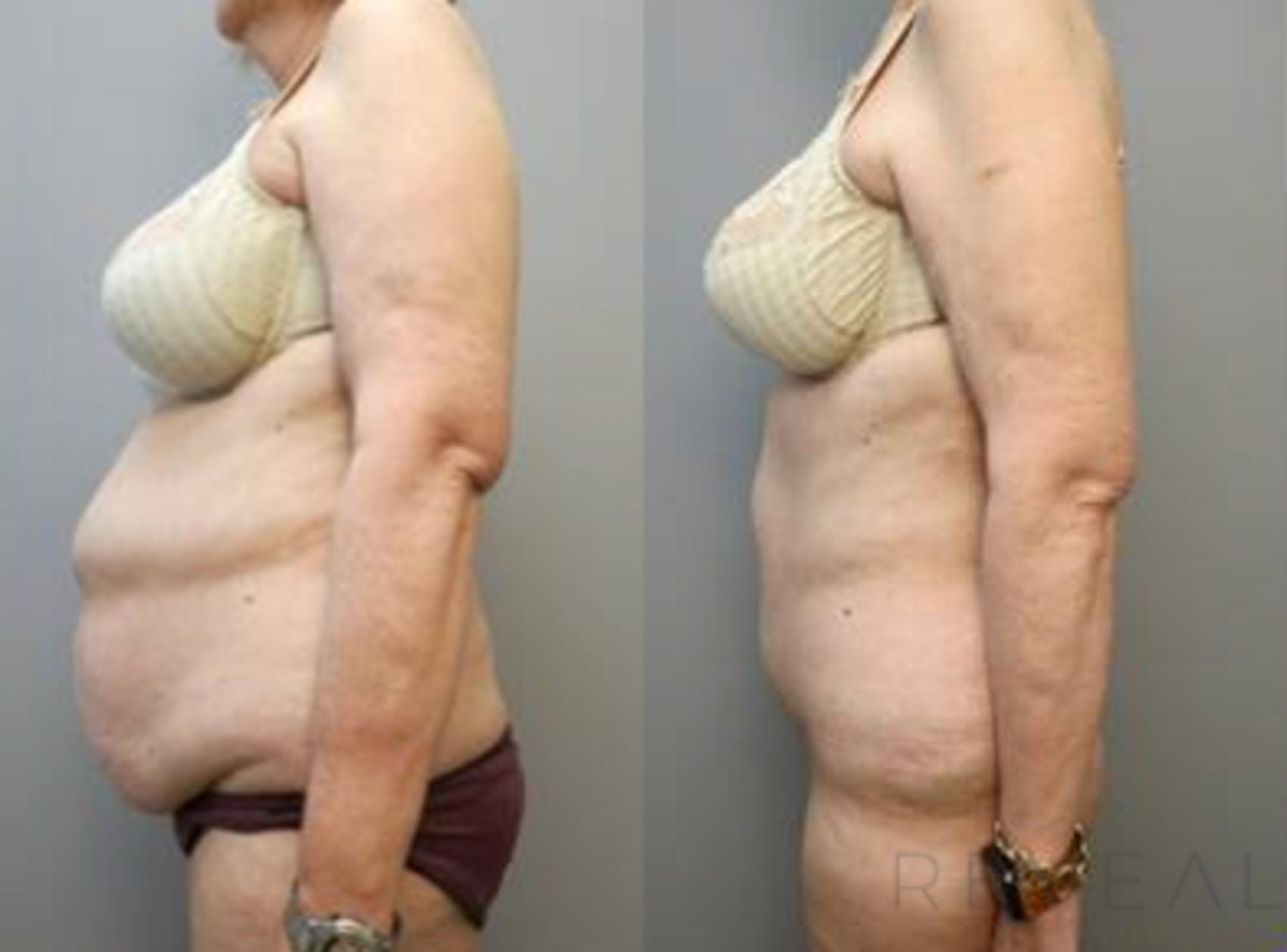 Before & After Tummy Tuck Case 463 View #1 View in San Jose, CA
