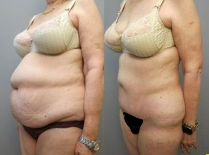 Before & After Tummy Tuck Case 463 View #2 View in San Jose, CA