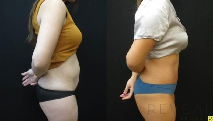 Before & After Tummy Tuck Case 480 View #1 View in San Jose, CA