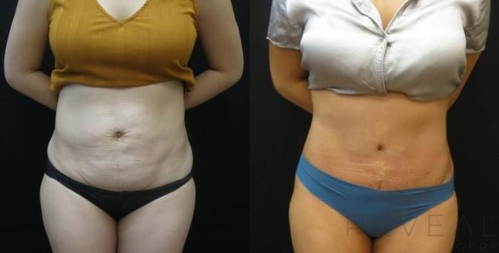 Before & After Tummy Tuck Case 480 View #2 View in San Jose, CA