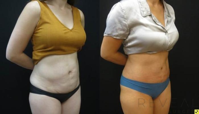 Before & After Tummy Tuck Case 480 View #3 View in San Jose, CA