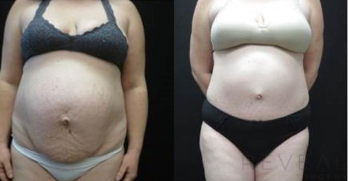 Before & After Tummy Tuck Case 481 View #1 View in San Jose, CA