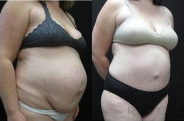 Before & After Tummy Tuck Case 481 View #2 View in San Jose, CA