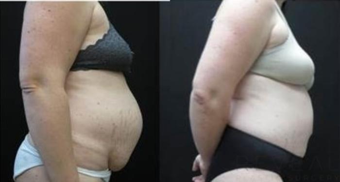 Before & After Tummy Tuck Case 481 View #3 View in San Jose, CA