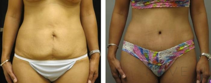 Before & After Tummy Tuck Case 493 View #1 View in San Jose, CA
