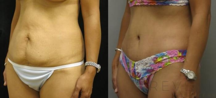 Before & After Tummy Tuck Case 493 View #2 View in San Jose, CA