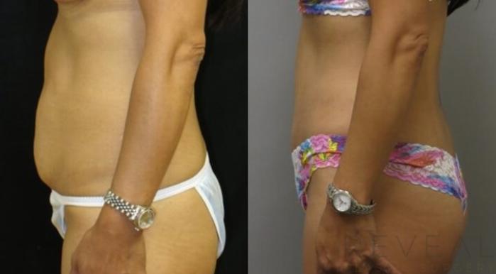 Before & After Tummy Tuck Case 493 View #3 View in San Jose, CA