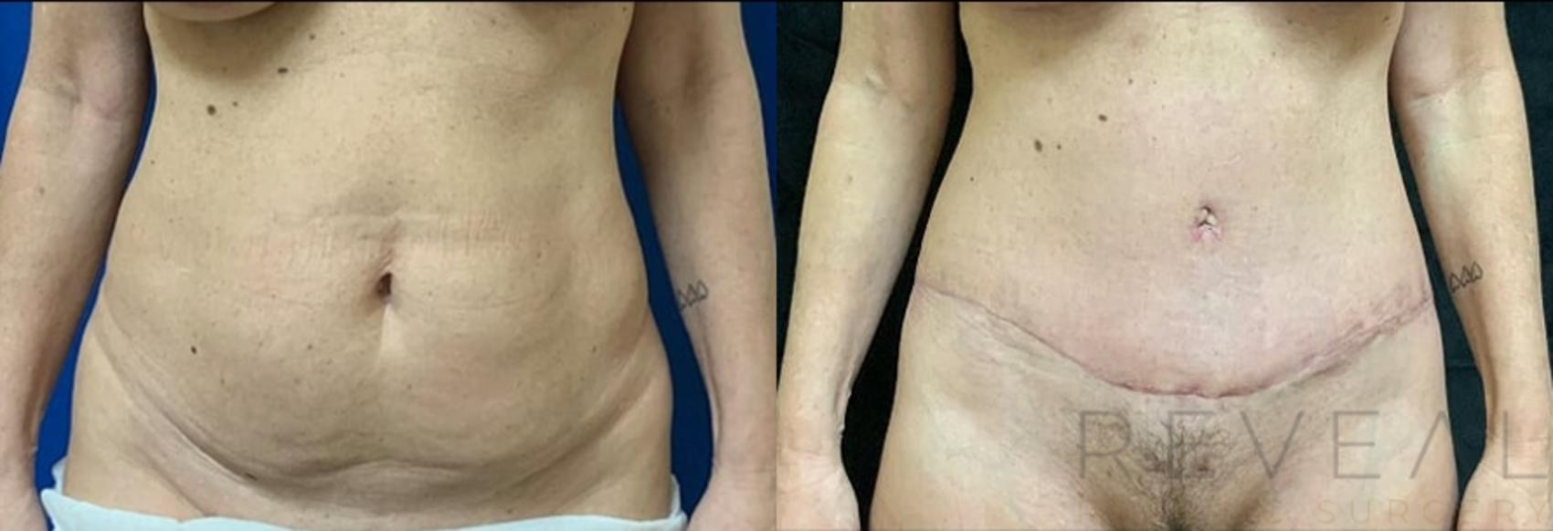 Before & After Tummy Tuck Case 501 View #1 View in San Jose, CA