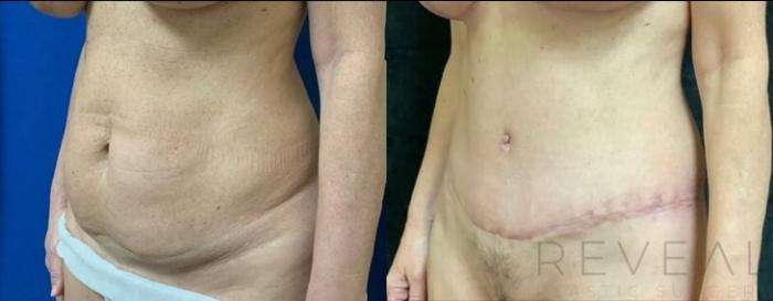 Before & After Tummy Tuck Case 501 View #2 View in San Jose, CA