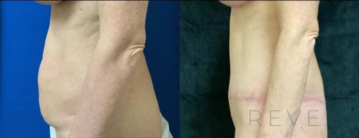 Before & After Tummy Tuck Case 501 View #3 View in San Jose, CA