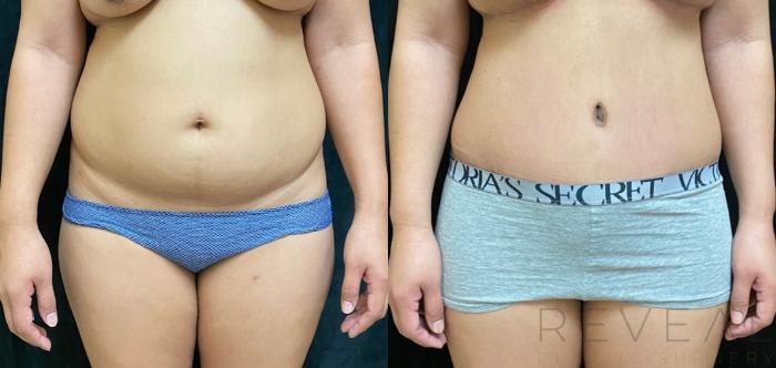 Before & After Tummy Tuck Case 507 View #2 View in San Jose, CA