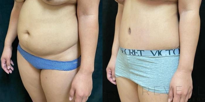 Before & After Tummy Tuck Case 507 View #3 View in San Jose, CA