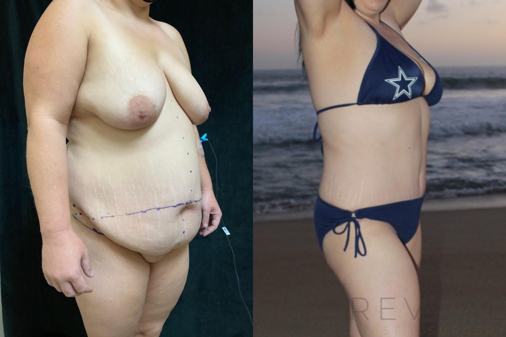 Before & After Tummy Tuck Case 514 View #1 View in San Jose, CA