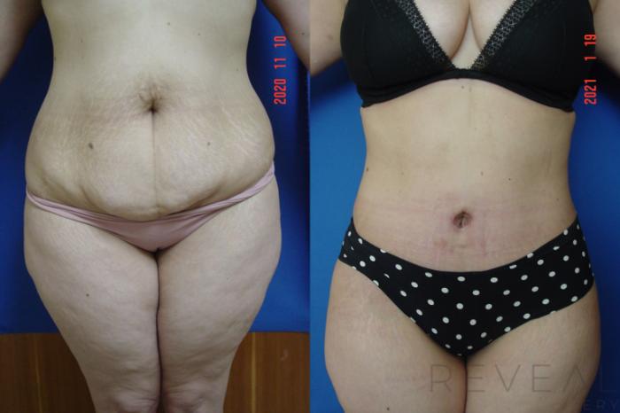 Before & After Liposuction Case 522 View #1 View in San Jose, CA