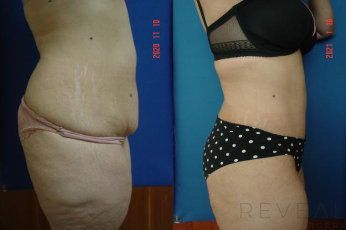 Before & After Liposuction Case 522 View #2 View in San Jose, CA