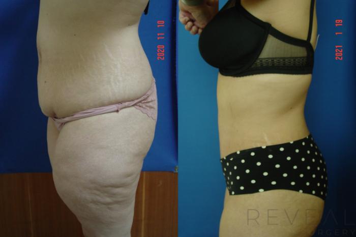 Before & After Liposuction Case 522 View #3 View in San Jose, CA