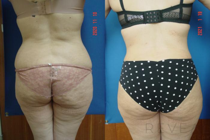 Before & After Tummy Tuck Case 522 View #4 View in San Jose, CA