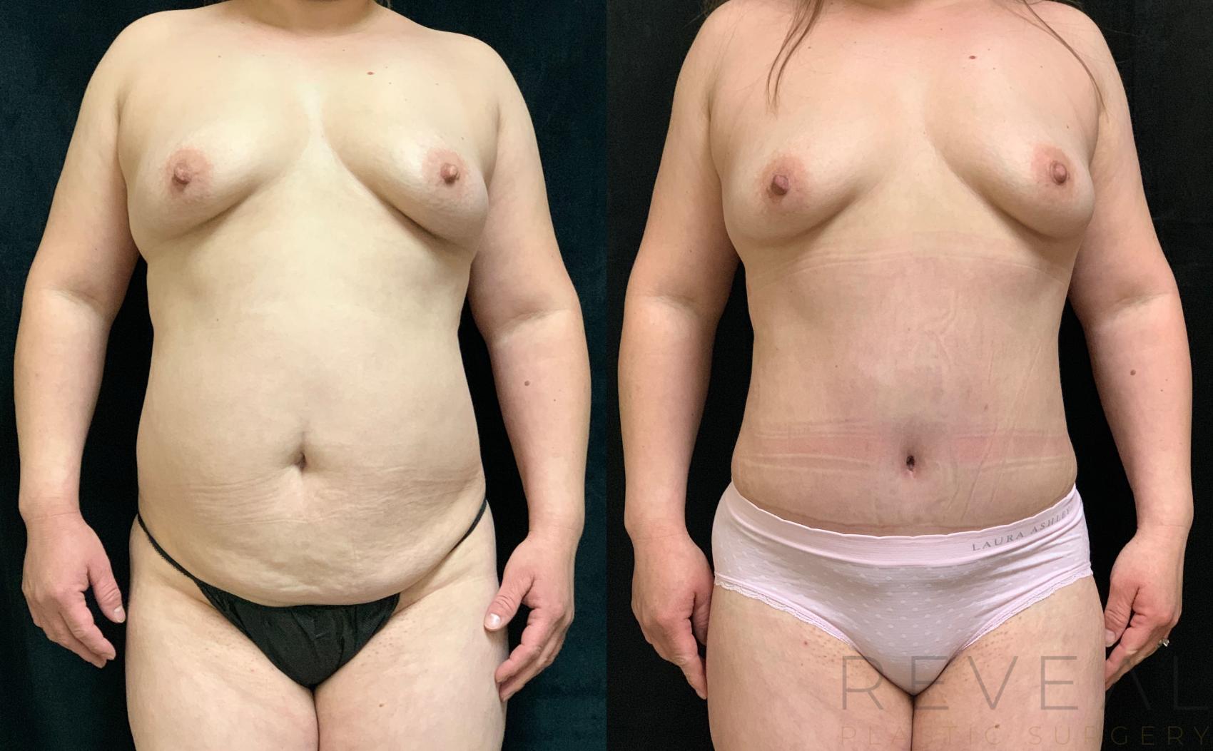 Before & After Liposuction Case 528 View #1 View in San Jose, CA