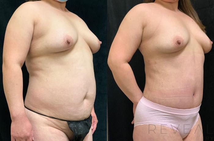 Before & After Tummy Tuck Case 528 View #2 View in San Jose, CA