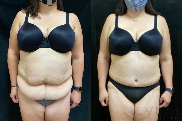 Before & After Tummy Tuck Case 535 View #1 View in San Jose, CA