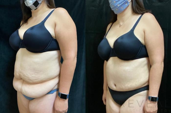 Before & After Tummy Tuck Case 535 View #2 View in San Jose, CA