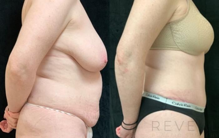 Before & After Tummy Tuck Case 541 View #1 View in San Jose, CA