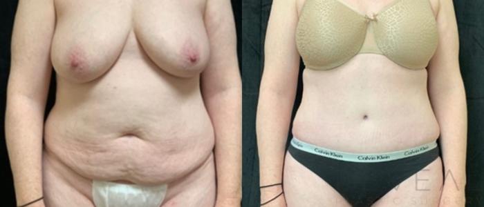 Before & After Tummy Tuck Case 541 View #2 View in San Jose, CA